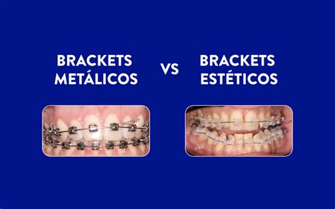 brackets esteticos vs metalicos|bracket autoligado vs convencional.